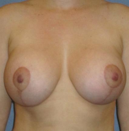 Breast Lift Before & After Patient #1371