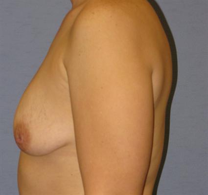 Breast Lift Before & After Patient #1371