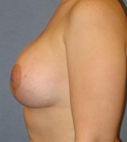 Breast Lift Before & After Patient #1371