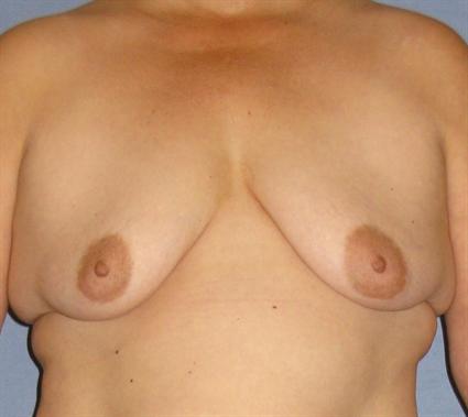 Breast Lift Before & After Patient #1364