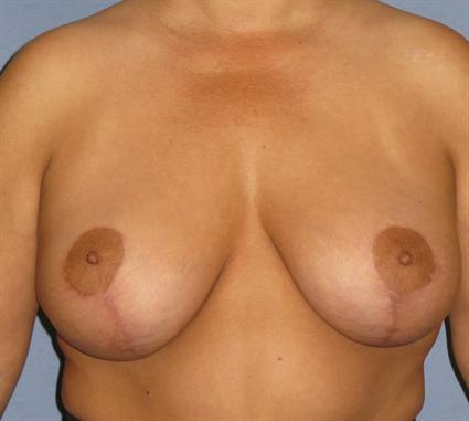 Breast Lift Before & After Patient #1364