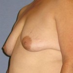 Breast Lift Before & After Patient #1364