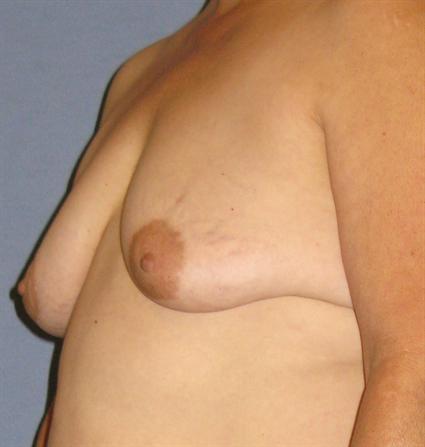 Breast Lift Before & After Patient #1364