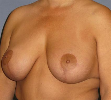 Breast Lift Before & After Patient #1364