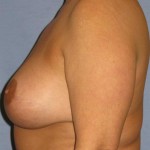 Breast Lift Before & After Patient #1364