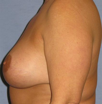 Breast Lift Before & After Patient #1364