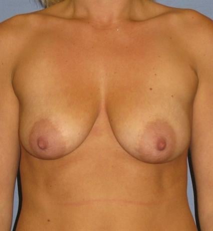 Breast Lift Before & After Patient #1357