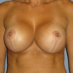 Breast Lift Before & After Patient #1357