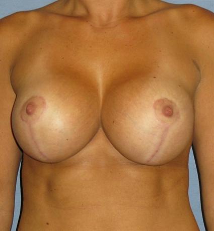 Breast Lift Before & After Patient #1357