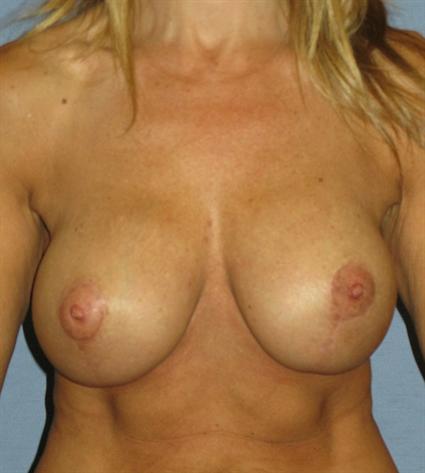 Breast Lift Before & After Patient #1350