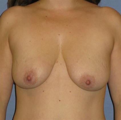 Breast Lift Before & After Patient #1338