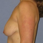 Breast Lift Before & After Patient #1338