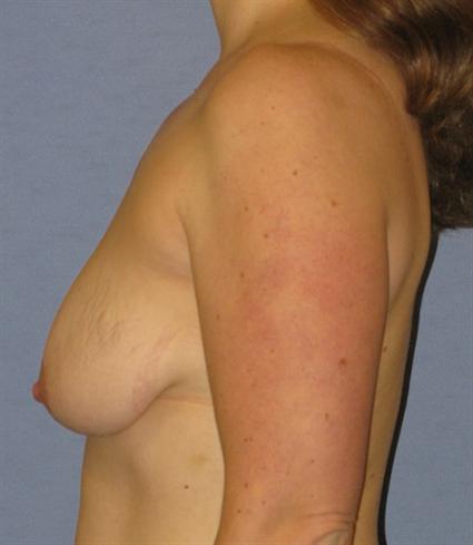 Breast Lift Before & After Patient #1338