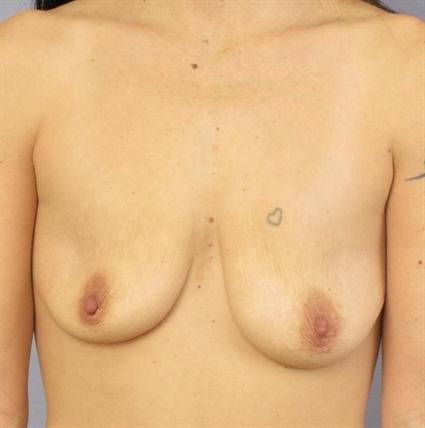 Breast Lift Before & After Patient #1331