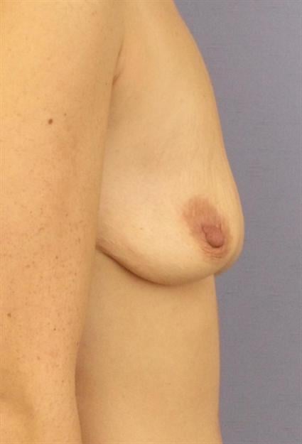 Breast Lift Before & After Patient #1331