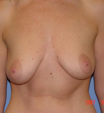 Breast Lift Before & After Patient #1326