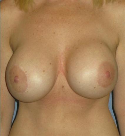 Breast Lift Before & After Patient #1326