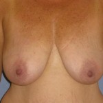 Breast Lift Before & After Patient #1321