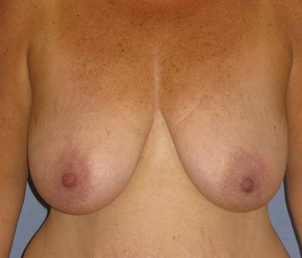 Breast Lift Before & After Patient #1321
