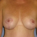 Breast Lift Before & After Patient #1321