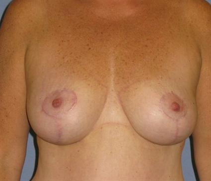 Breast Lift Before & After Patient #1321