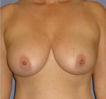 Breast Lift Before & After Patient #1318