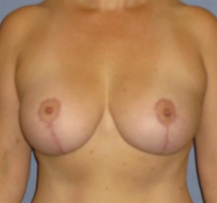 Breast Lift Before & After Patient #1318