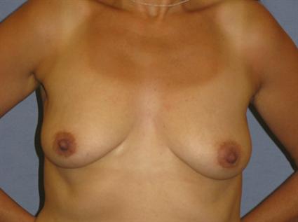 Breast Lift Before & After Patient #1311