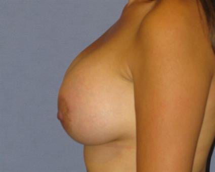 Breast Lift Before & After Patient #1311