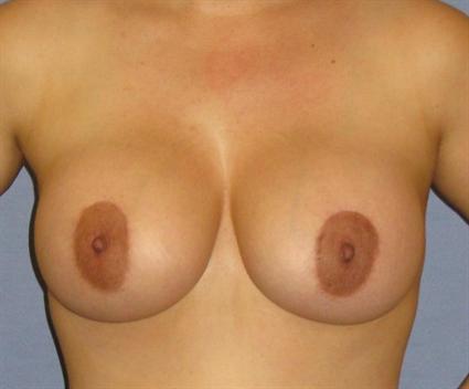 Breast Lift Before & After Patient #1304