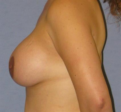 Breast Lift Before & After Patient #1304
