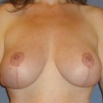 Breast Lift Before & After Patient #1297