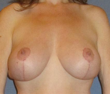 Breast Lift Before & After Patient #1297
