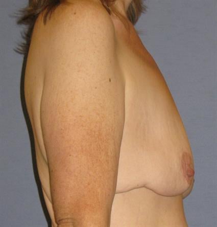 Breast Lift Before & After Patient #1297
