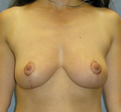 Breast Lift Before & After Patient #1285