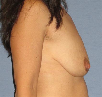 Breast Lift Before & After Patient #1285