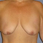 Breast Lift Before & After Patient #1278