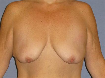 Breast Lift Before & After Patient #1278