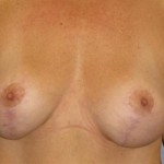 Breast Lift Before & After Patient #1278