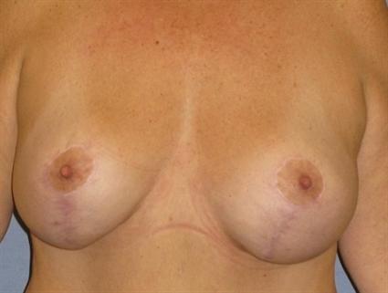 Breast Lift Before & After Patient #1278