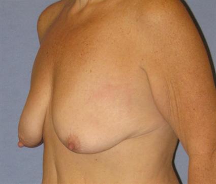 Breast Lift Before & After Patient #1278