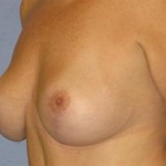 Breast Lift Before & After Patient #1278