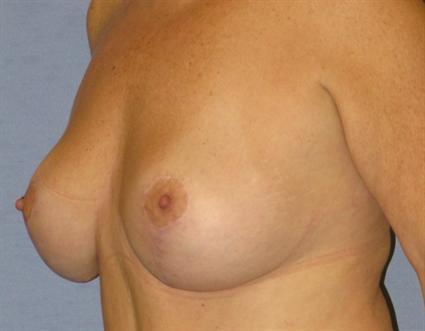 Breast Lift Before & After Patient #1278