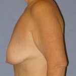 Breast Lift Before & After Patient #1278