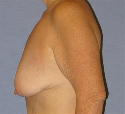 Breast Lift Before & After Patient #1278