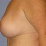 Breast Lift Before & After Patient #1278