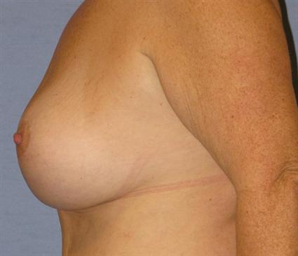 Breast Lift Before & After Patient #1278