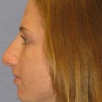 Rhinoplasty Before & After Patient #1719