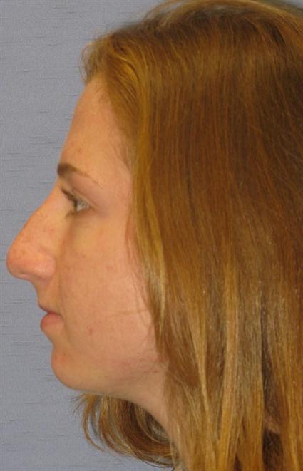 Rhinoplasty Before & After Patient #1719
