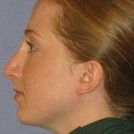 Rhinoplasty Before & After Patient #1719